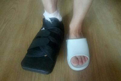 拇外翻全国足踝外科顶级专家,精细化手术