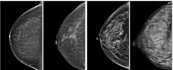 乳腺结节bi-rads分级依据,国内乳腺结节bi-rads分级标准