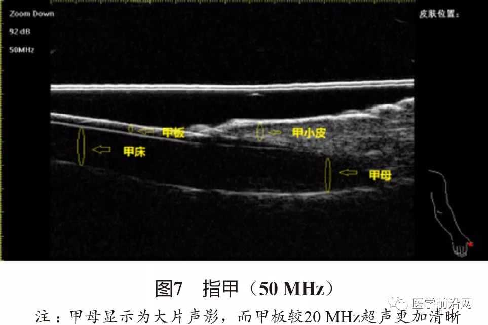 常见皮肤病高频皮肤超声诊断专家共识全文发布
