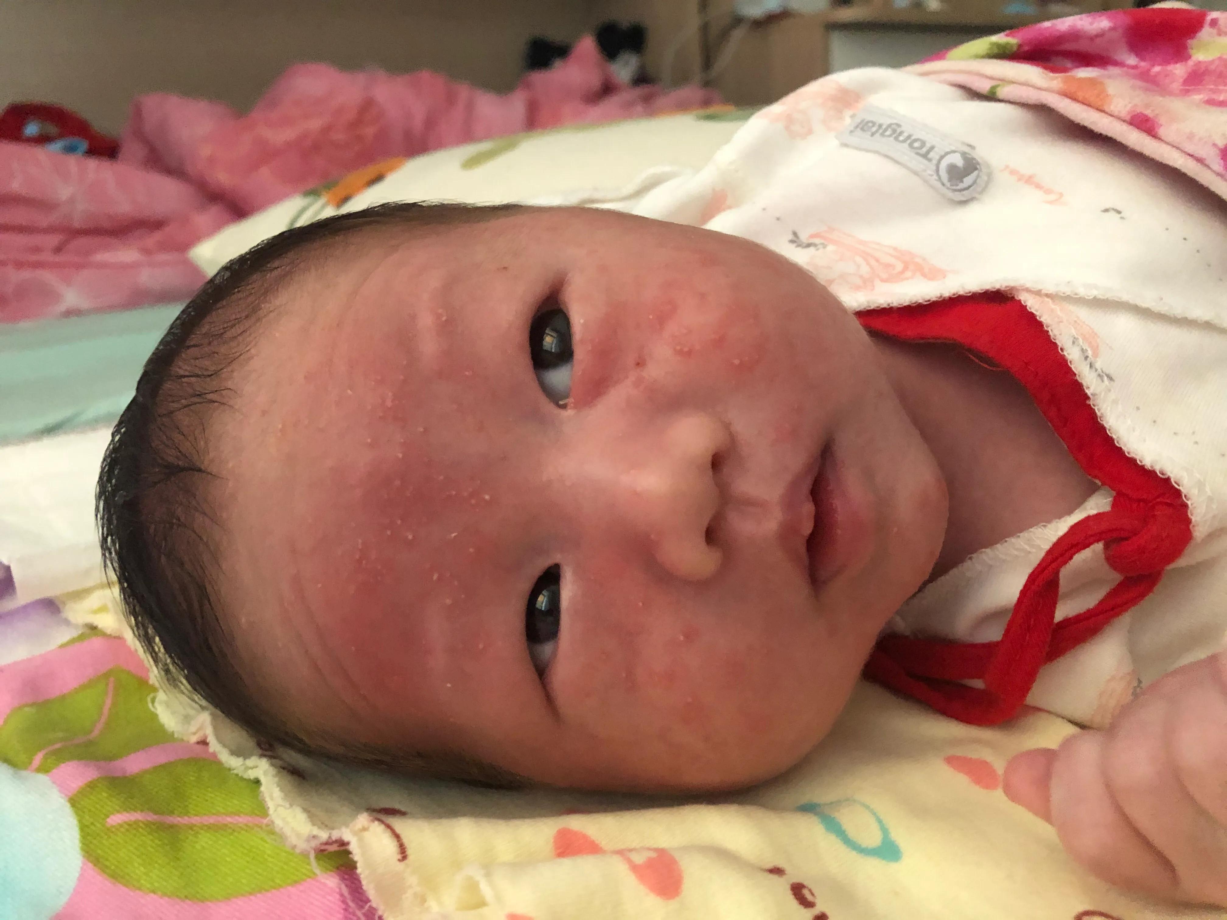 新生儿宝宝全身出红疹,新生儿满脸疹子