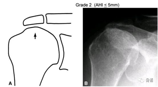 巨大肩袖撕裂概念图,右肩袖巨大撕裂