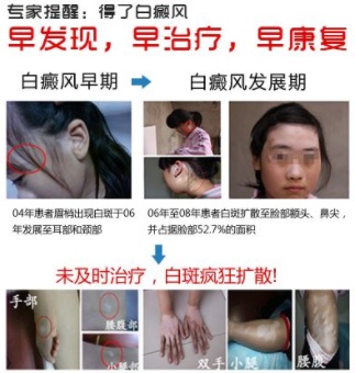 正确的白癜风预防方法,早期白癜风怎么治疗
