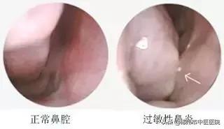 儿童患过敏性鼻炎怎么办,宝宝患过敏性鼻炎怎么办