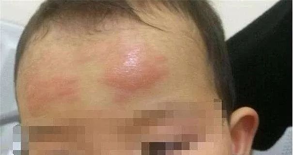 “退热贴”骗了多少中国父母！国内外指南从来没有承认过！​