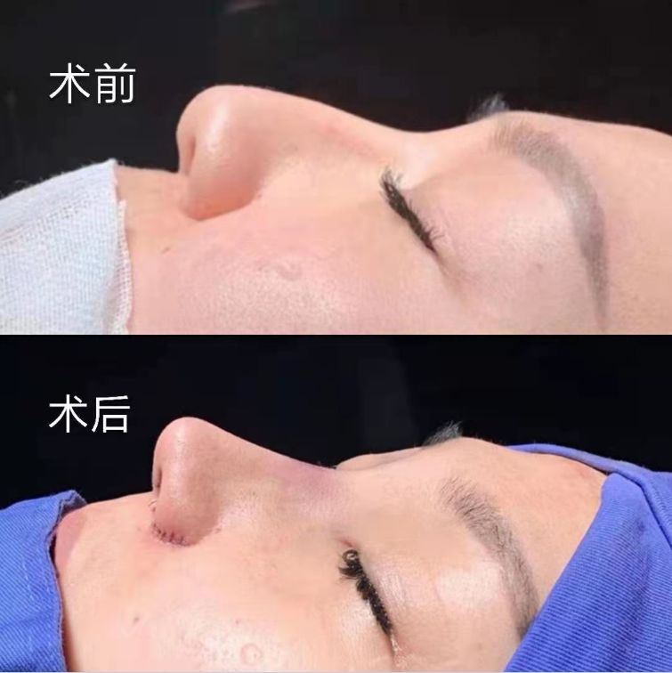 一次隆鼻手术一般几个切口,山根低鼻梁塌鼻翼大怎么隆鼻