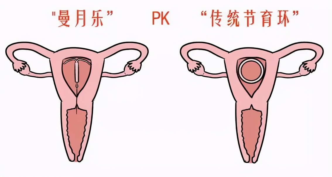 这个小玩意不仅能防“意外”，还能治疗妇科病