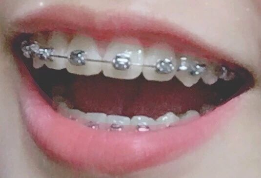 整牙齿堪比整容,矫正牙齿大概多少钱龅牙