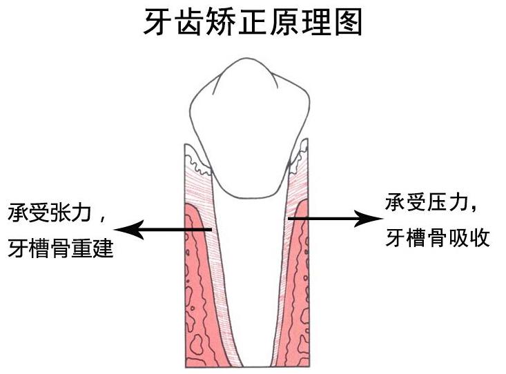 正畸失败的处理方法,正畸失败植骨