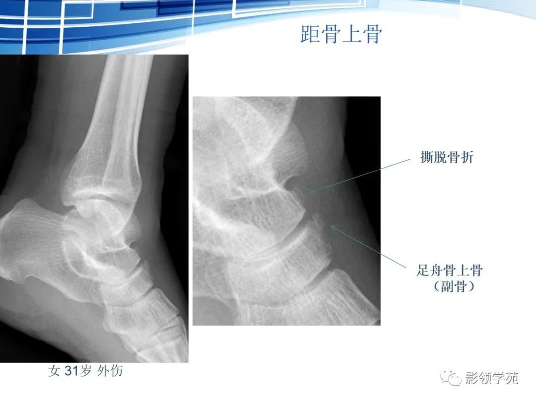 桡骨远端骨折引起尺骨变异,撕脱骨折一个月无明显骨痂形成