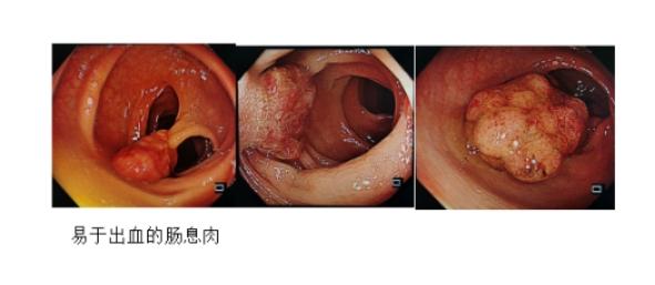 肠息肉切除术后出血了怎么办,肠息肉切除术后出血怎么办