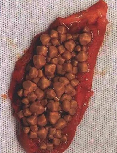 胆结石胆囊息肉不切除怎样治疗,胆囊息肉为什么不做保胆