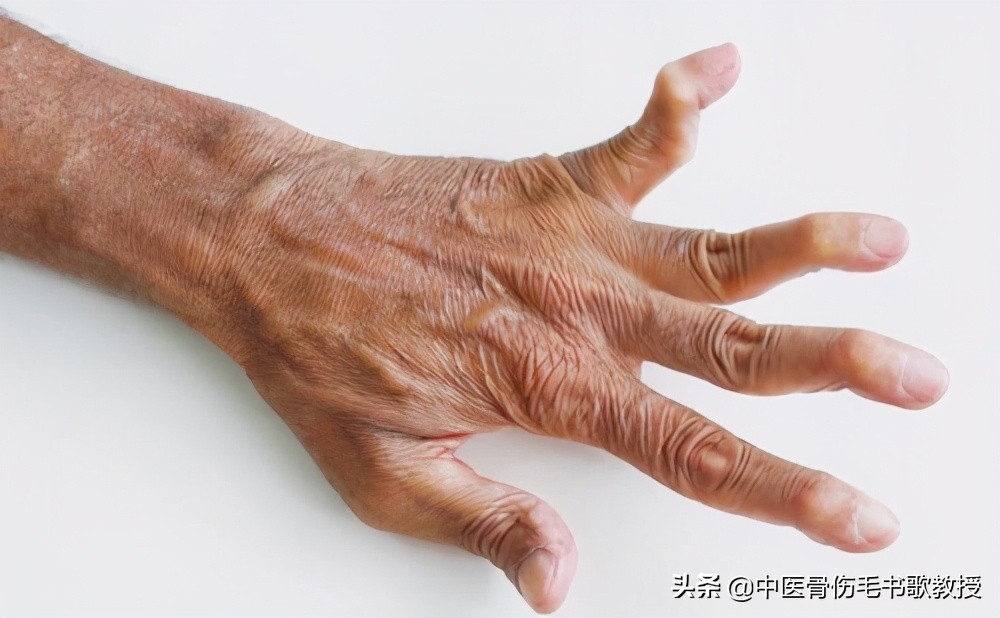 手指关节痛属于风湿还是类风湿,手指关节僵硬膝盖都疼是什么病兆