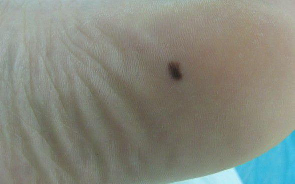 色素痣如何判断病变,色素痣怎么看出有癌变可能