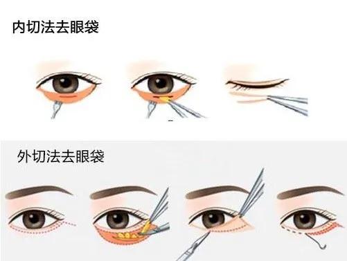 关于眼袋,眼袋的形成原因