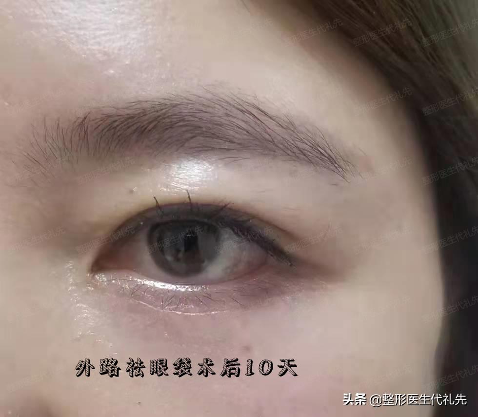 医美专家聊整形知到答案,整形医生谈去黑眼圈