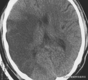 生命健康有哪些方面,临床症状脑血栓形成