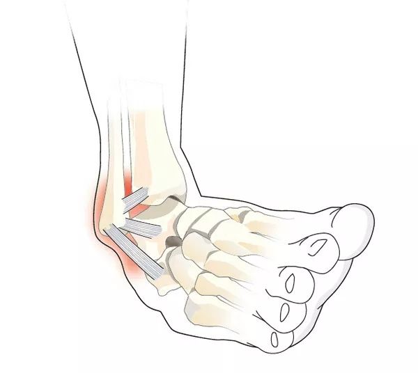 瑜伽拉伸不是拉韧带，韧带拉伤后果很严重