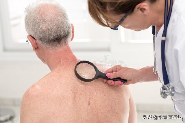 银屑病外用特效药伤肝不,银屑病用什么药见效快还没副作用