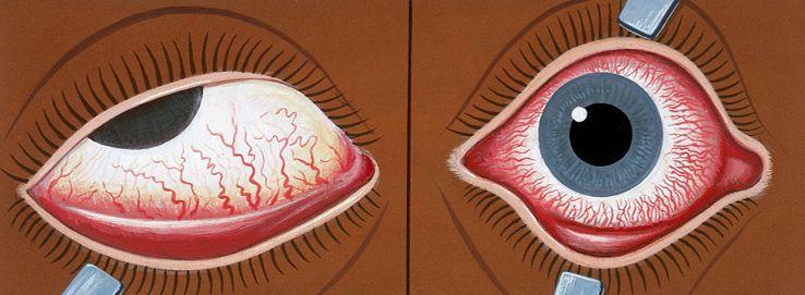 新冠肺炎眼部症状,面对新冠肺炎疫情大家如何预防