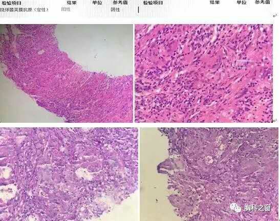 拍片查出肺结节,拍ct肺结节误诊的几率多大