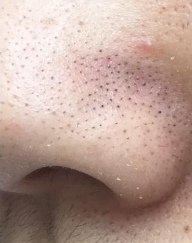 顽固黑头怎么去除最有效,祛除黑头最有效的方法