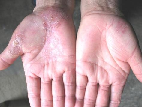 远离真菌,验方治愈一切真菌感染皮肤病