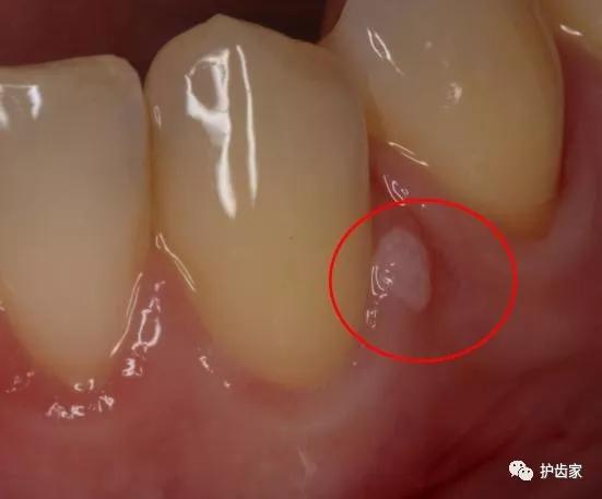 补完牙牙龈反复出现脓包怎么治疗,根管治疗的牙龈反复长脓包怎么办