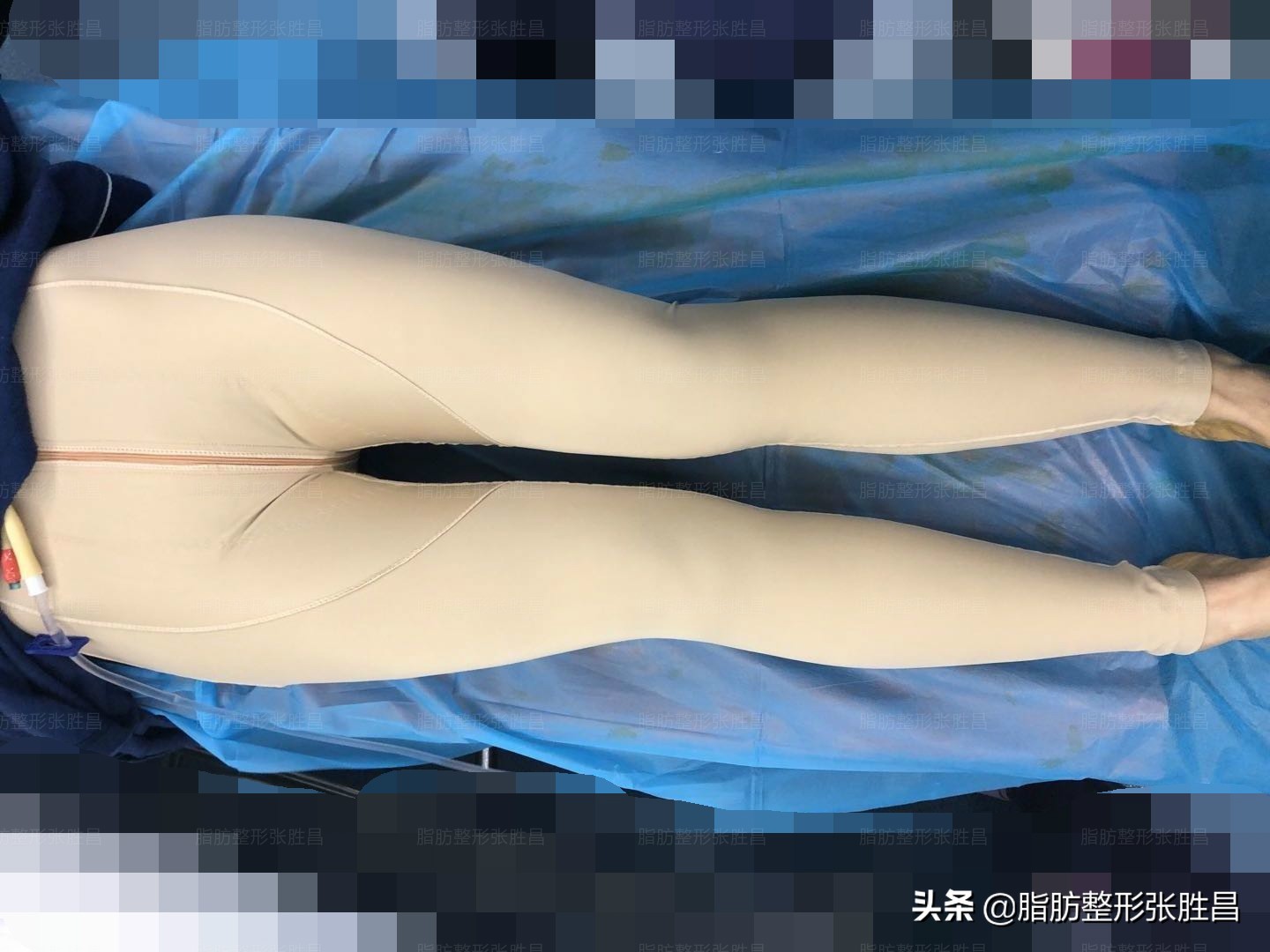 大腿环吸多久可以瘦腿,大腿环吸手术能穿内裤么