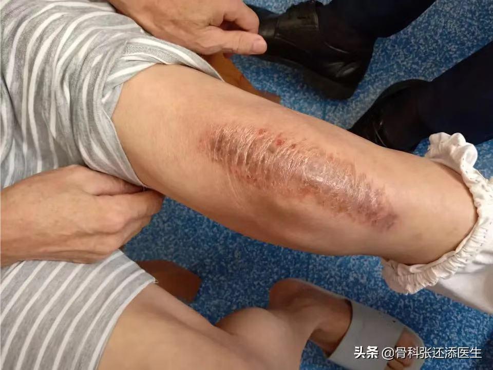 肛肠中药熏洗适应症,中药熏洗有用吗