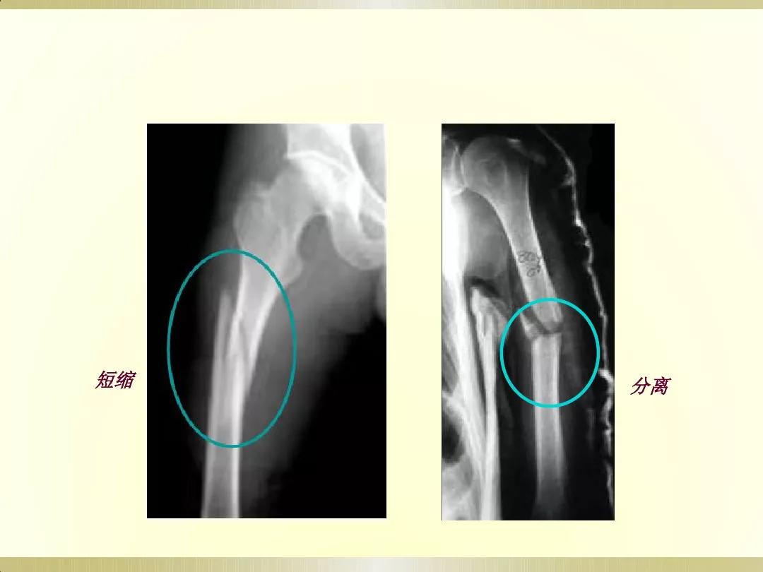 骨科x光片读片技巧,放射科骨科读片教程