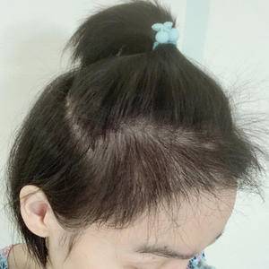 发际线太高怎么办初中生,发际线太高怎么办学生党