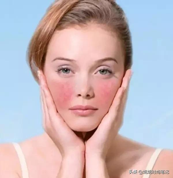 春季皮肤过敏干燥起皮怎么办,过敏是皮肤干燥引起的吗