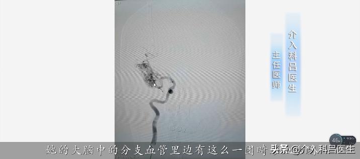 50岁大姐出车祸,50岁大姐脑出血康复成功案例