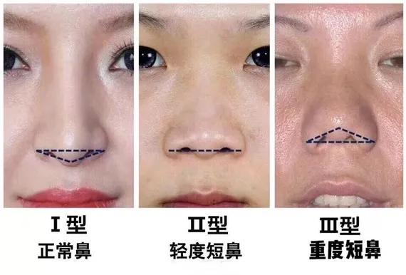 全世界公认的最有效的瘦鼻法,短鼻和扁平鼻的区别