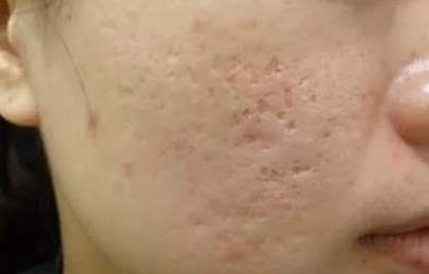 痘痘不挤痘印消不掉吗,红色痘印一直消不掉