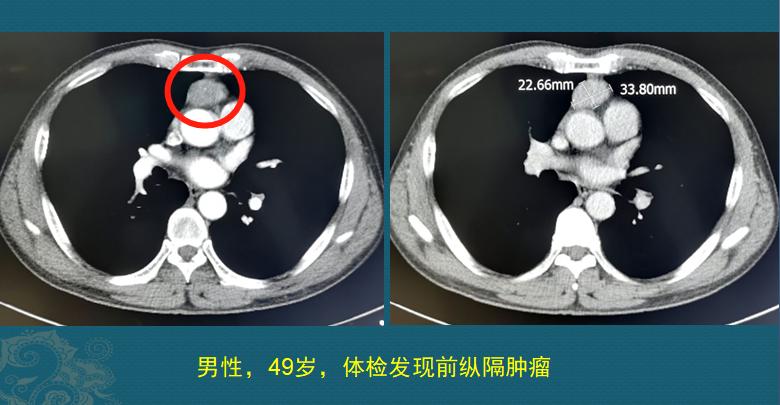 通过健康体检能检查出癌症吗,健康体检是防癌吗
