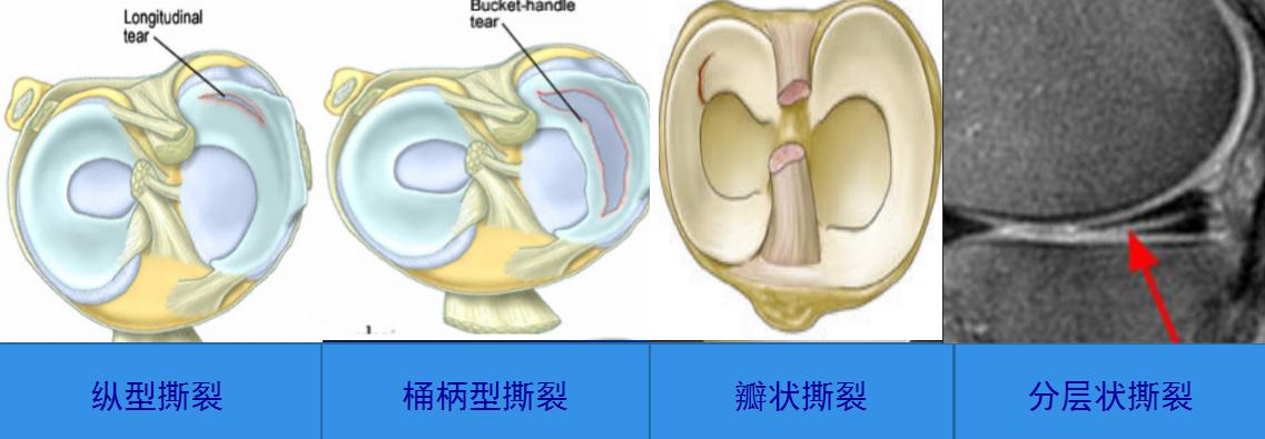 半月板损伤康复训练,半月板损伤膝盖疼的最好治疗方法
