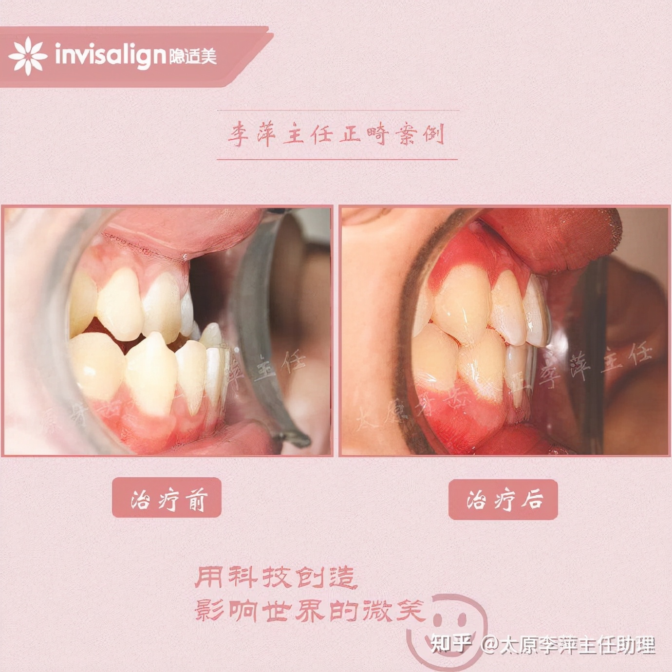 重度拥挤矫正牙齿适合隐形牙套吗,广州成人牙齿矫正推荐隐形牙套