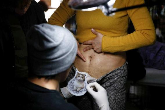 剖腹产5年了还不敢生,五年内剖腹产四次