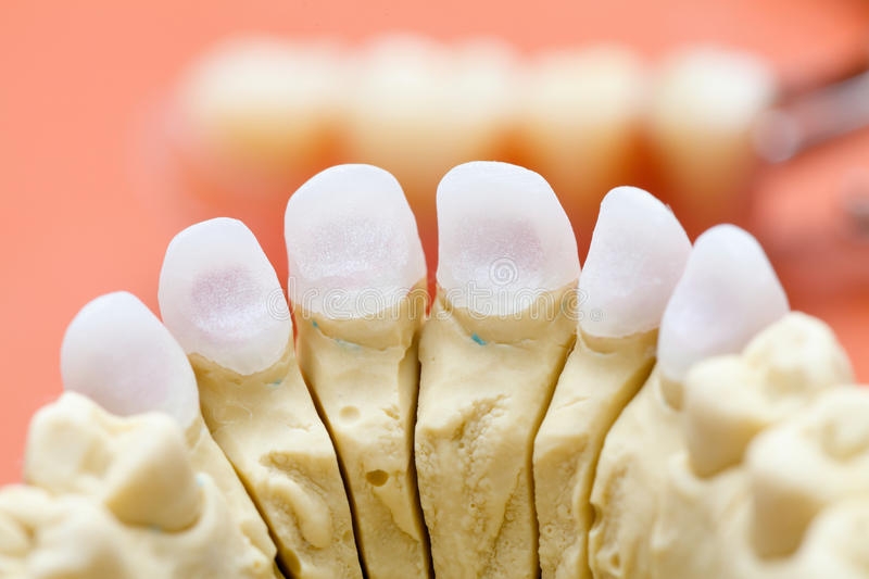 牙齿根管治疗后不戴牙冠可以吗,根管治疗没做牙套牙裂开了怎么办