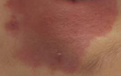 红胎记和青胎记哪个好治疗,红胎记血管瘤的治疗方法有哪些