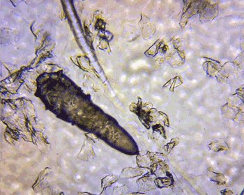 螨虫会导致背部泛红瘙痒,后背螨虫感染多长时间可以治愈