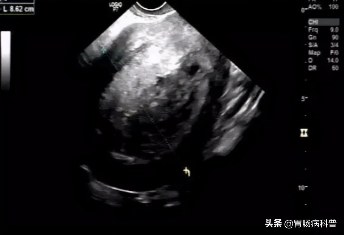 七十岁老太太腿部长了个肉疙瘩,70岁老太太患上了癌症