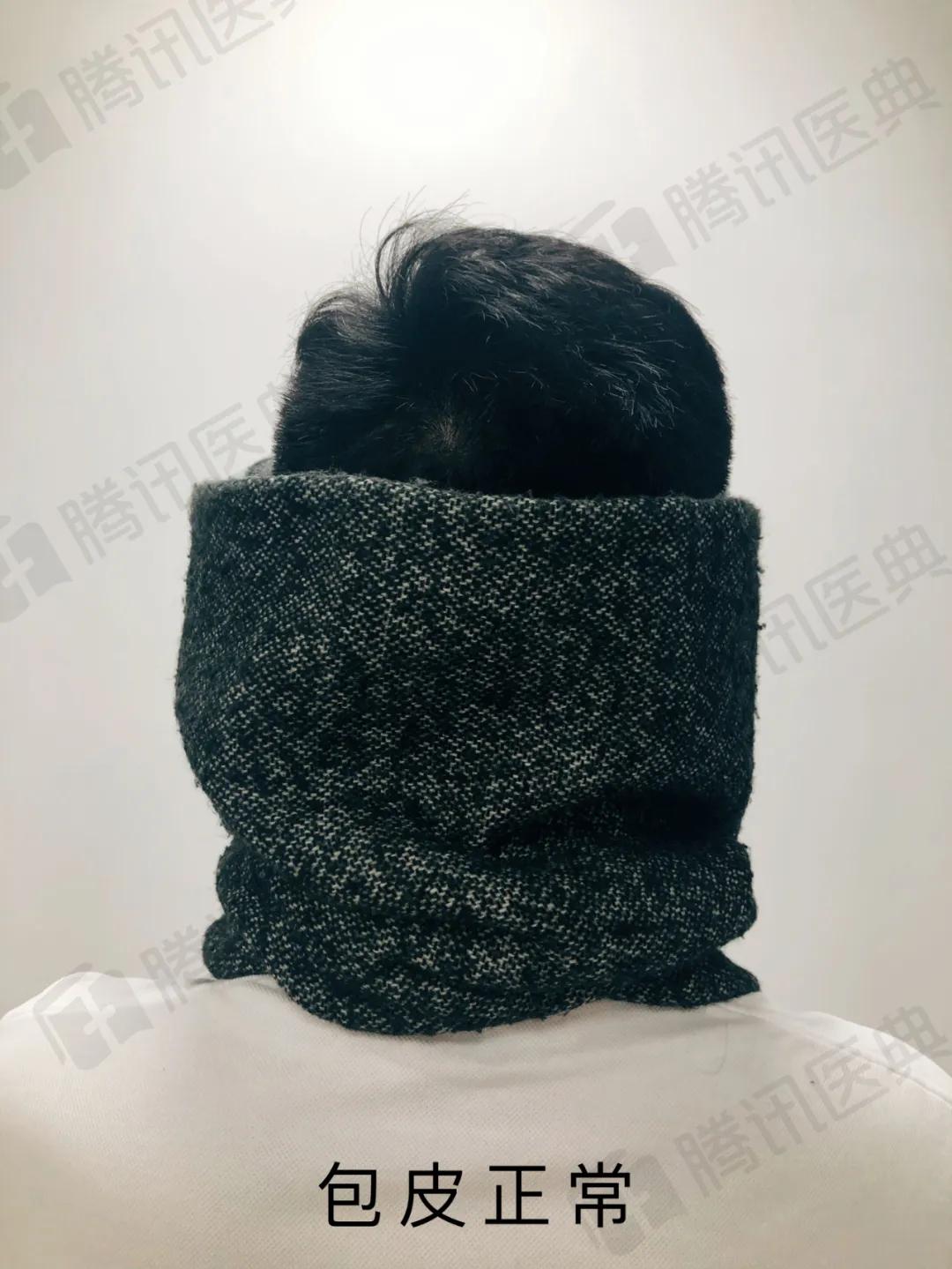 割包皮能治疗好疱疹吗,割包皮属于大手术么