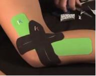 大腿外侧髂胫束综合征快速恢复,跑步如何避免髂胫束综合征