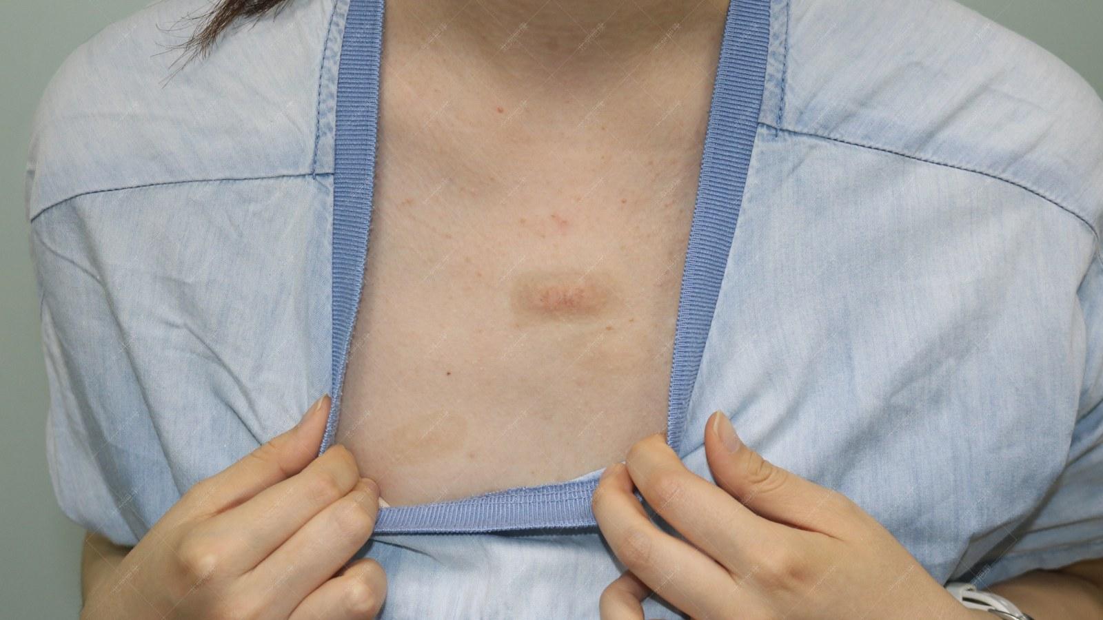 北京疤康怎么治疗疤痕,疤康医院治疗疤痕增生如何