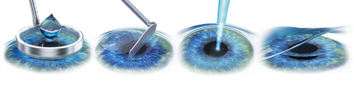 近视眼手术晶体移植和激光的区别,近视眼做了激光有什么利弊