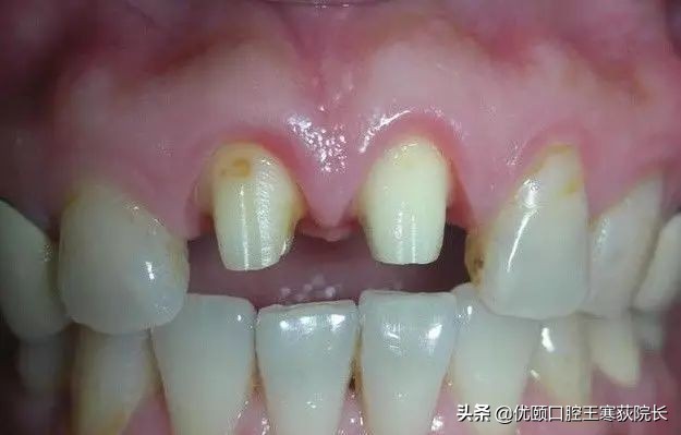 拔了一侧的两颗牙齿如何镶牙,镶一颗牙两侧牙齿不好怎么办