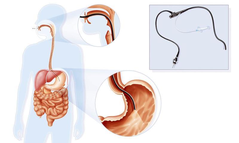 幽门螺杆菌感染能不能接吻,感染了幽门螺杆菌需要忌口吗