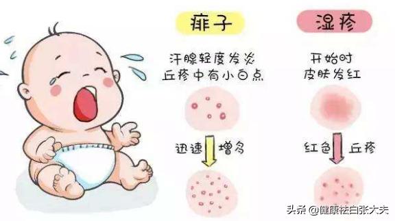 儿童湿疹引起白癜风能治好吗,湿疹后皮肤变白是白癜风吗